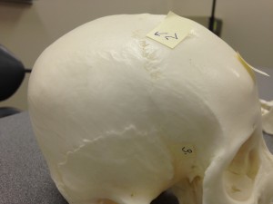 Point 2 labels the Coronal suture, which is seen on the lateral side of the skull. Beneath it is Point 3 which is the Sphenoid Bone, also seen in the lateral view of the skull.